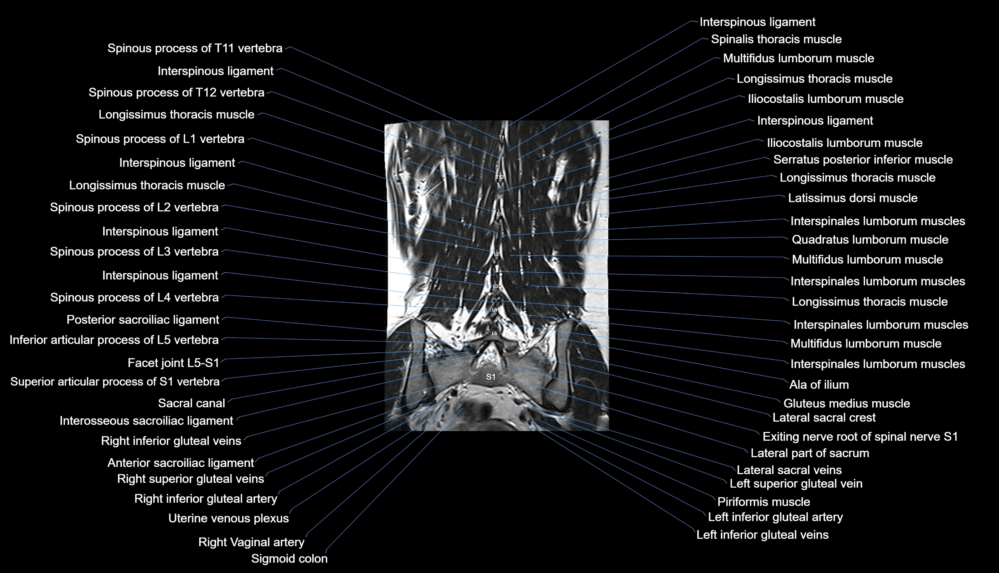 MRI lumbar spine labelled coronal cross sectional anatomy 3T radiology-img-00001-00027.webp